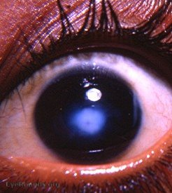 Central corneal leukoma