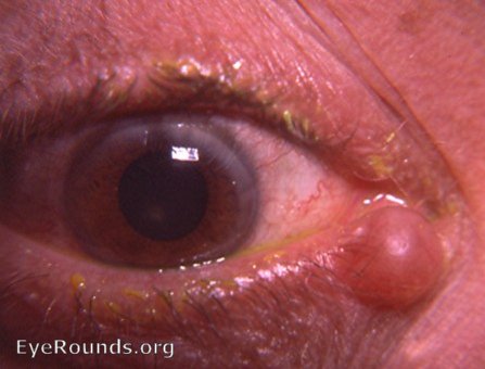 Cyst: cyst of gland of Moll; also, papilloma upper lid