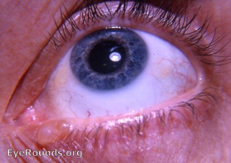 Cyst of a gland of Moll (a ciliary gland) . EyeRounds.org: Online ...