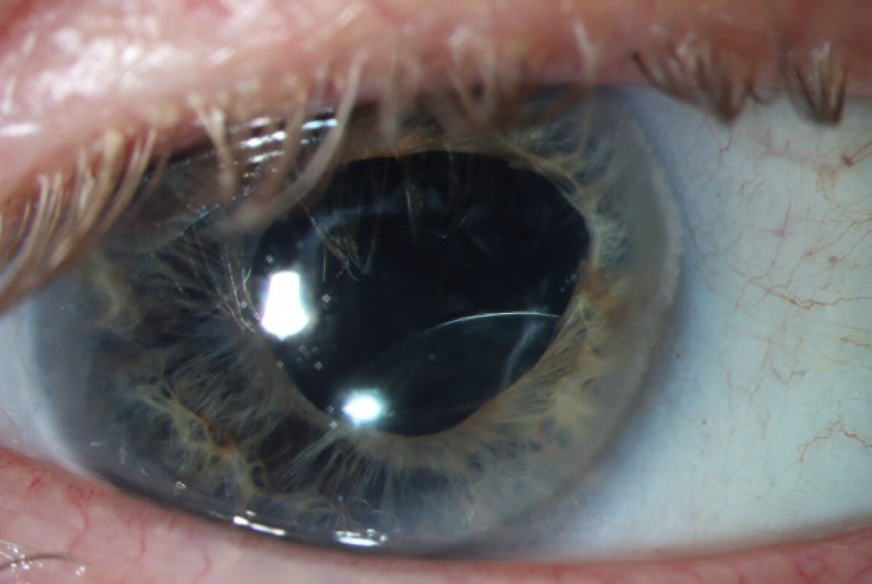 Decentered intraocular lens
