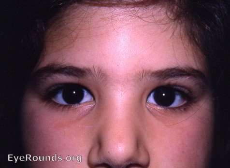 Epicanthal Folds Eyeroundsorg Online Ophthalmic Atlas