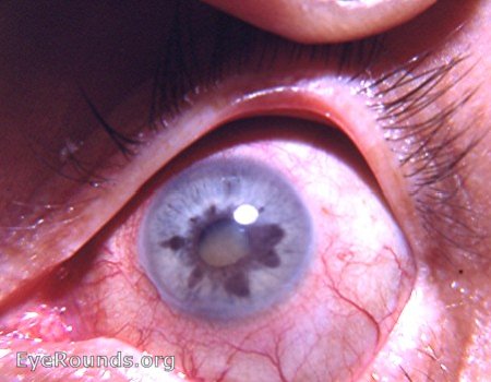 fuchs heterochromic heterochromia iridis chronic caused cataract atlas eyerounds iris uveitis atrophy complicata diagnosis differential between stage