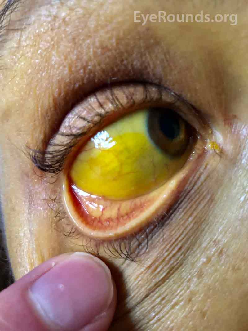 positive scleral icterus