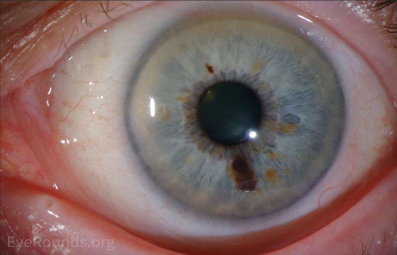 Iris melanoma