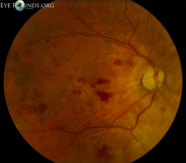  fundus after chemotherapy, and her follow-up fundus photos are shown below 1