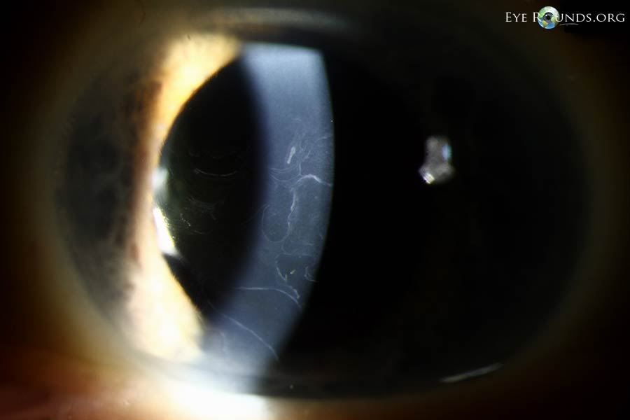 Enlarged slit lamp  Classic gray patches, fingerprint lines, map lines, dots, and cobblestone pattern in the corneal epithelium 