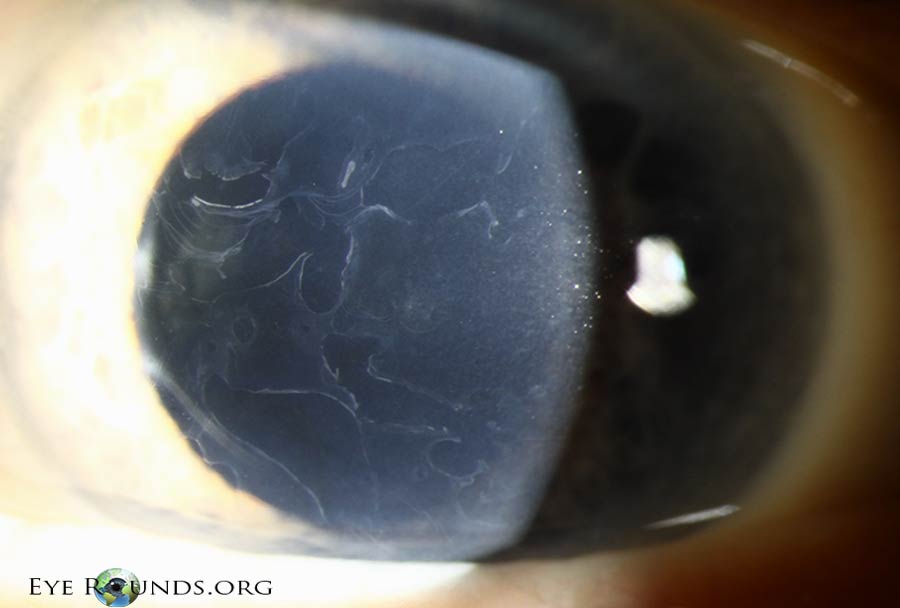 slit lamp  Classic gray patches, fingerprint lines, map lines, dots, and cobblestone pattern in the corneal epithelium 