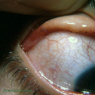 Pigmentation of conjunctiva by mascara