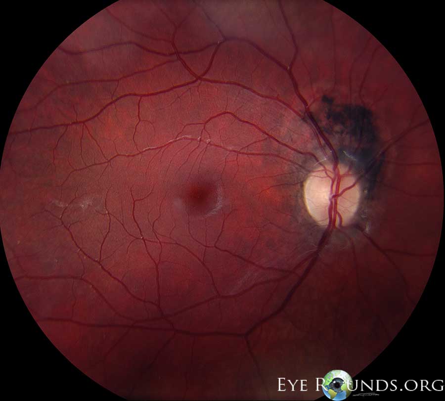 Related Atlas Entry: Melanocytoma of optic nerve