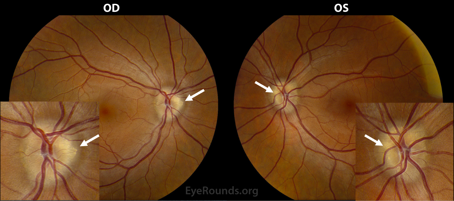 Color fundus photography. Both optic discs are 'lumpy bumpy' in appearance with highly refractile bodies seen extruding from the disc margins