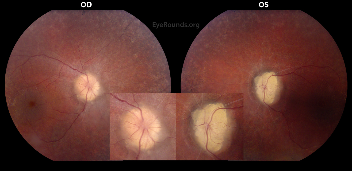 Color fundus photograph of the right and left eyes from a 15 year old boy with autosomal dominant retinitis pigmentosa and exposed optic disc drusen