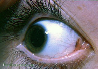 Pigmentation of plica semilunaris. EyeRounds.org: Online ...