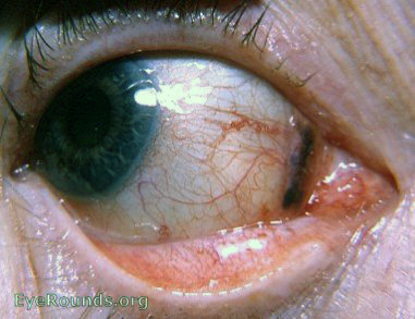 Pigmented nevus of plica semilunaris. EyeRounds.org ...
