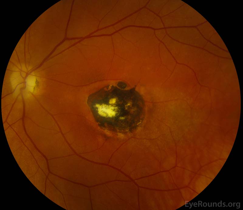 Ocular toxoplasmosis