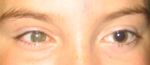 Norrie's disease with tractional retinal detachment face view