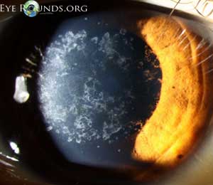 Inherited Eye Disease: Online Atlas of Ophthalmology