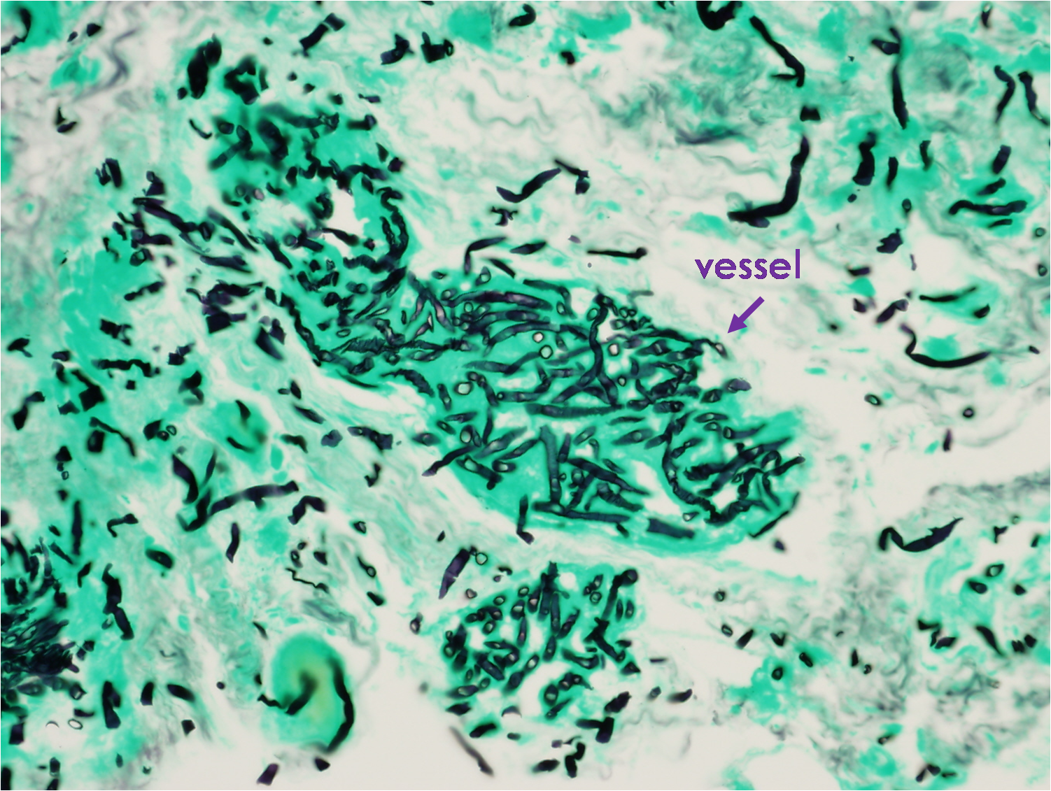 Figure 10. GMS stain demonstrating angioinvasion