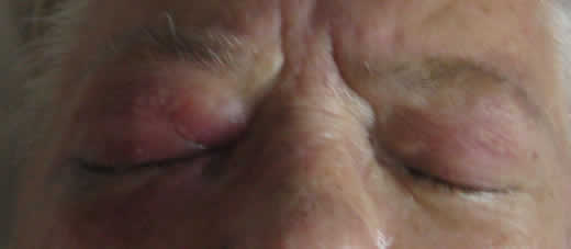 External Photograph showing periocular edema and erythema