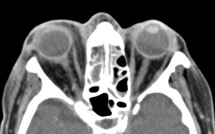 Figure 4. Pansinusitis with heterogeneous mucosal thickening is seen in the bilateral maxillary sinuses, the nasal cavity, the ethmoid sinuses, the sphenoid sinuses, and the right frontal sinus. No bony erosion is evident. There is soft tissue swelling or the preseptal tissue on the right. 