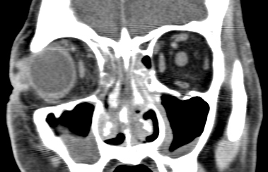 figure 5. Pansinusitis with heterogeneous mucosal thickening is seen in the bilateral maxillary sinuses, the nasal cavity, the ethmoid sinuses, the sphenoid sinuses, and the right frontal sinus. No bony erosion is evident. There is soft tissue swelling or the preseptal tissue on the right. 