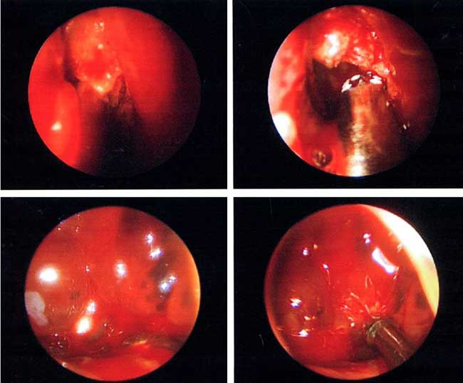Figure 6. Intraoperative endoscopic photographs nshowing pale sinus mucosa with edematous and necrotic tissue.