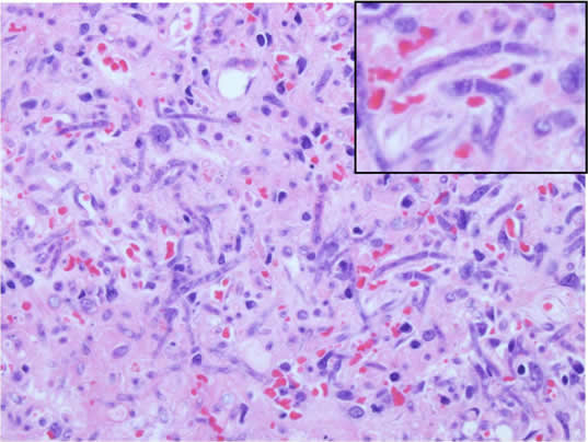 Hemotoxylin and Eosin stain histopathology shows necrotic and edematous tissue with neutrophilic inflitrate and hyphae