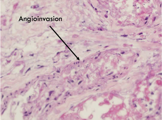 Figure 9. H and E blood vessels appear thrombosed, and angioinvasion by hyphae is noted