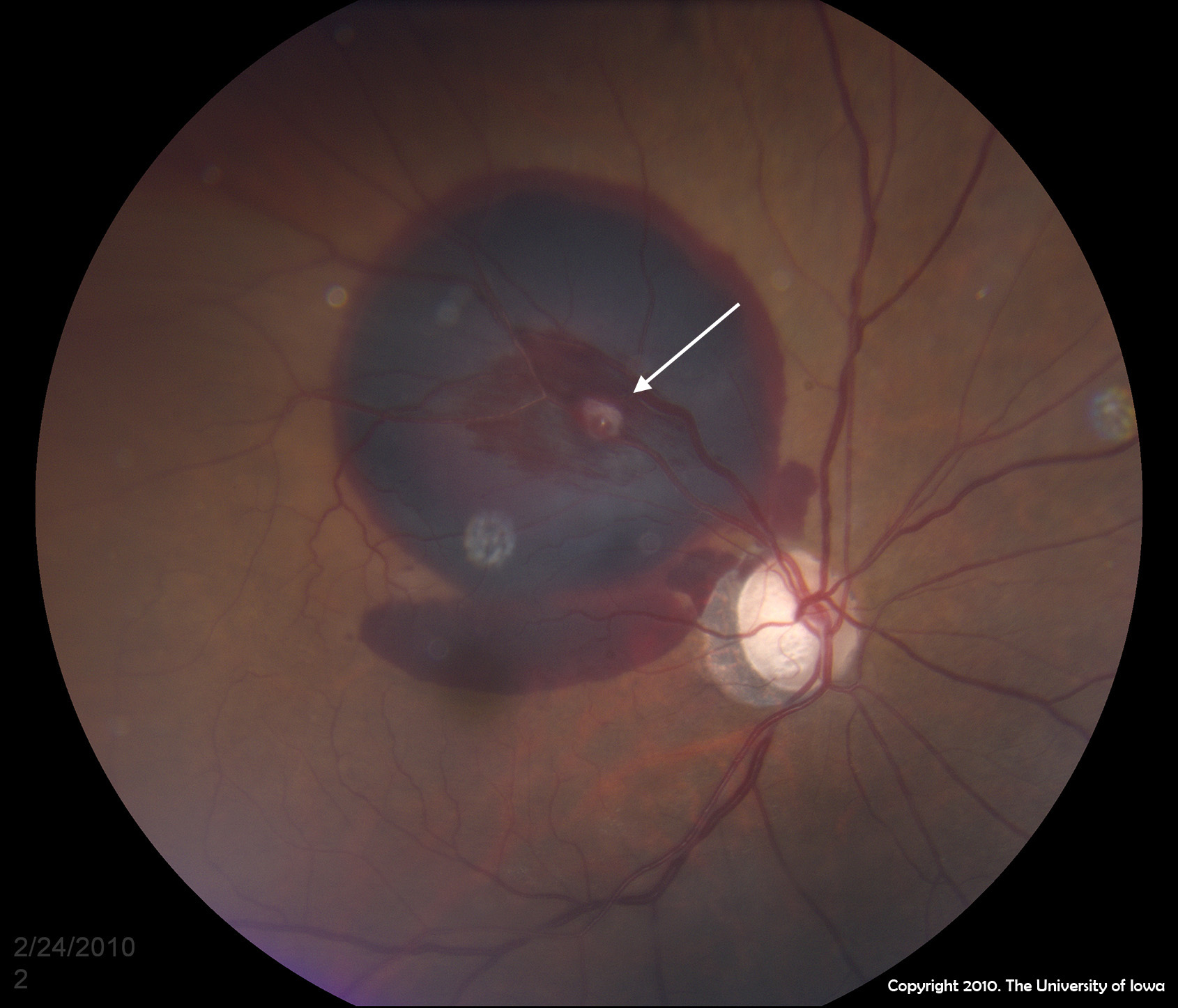 Retinal Artery Macroaneurysm Rama Ophthalmology
