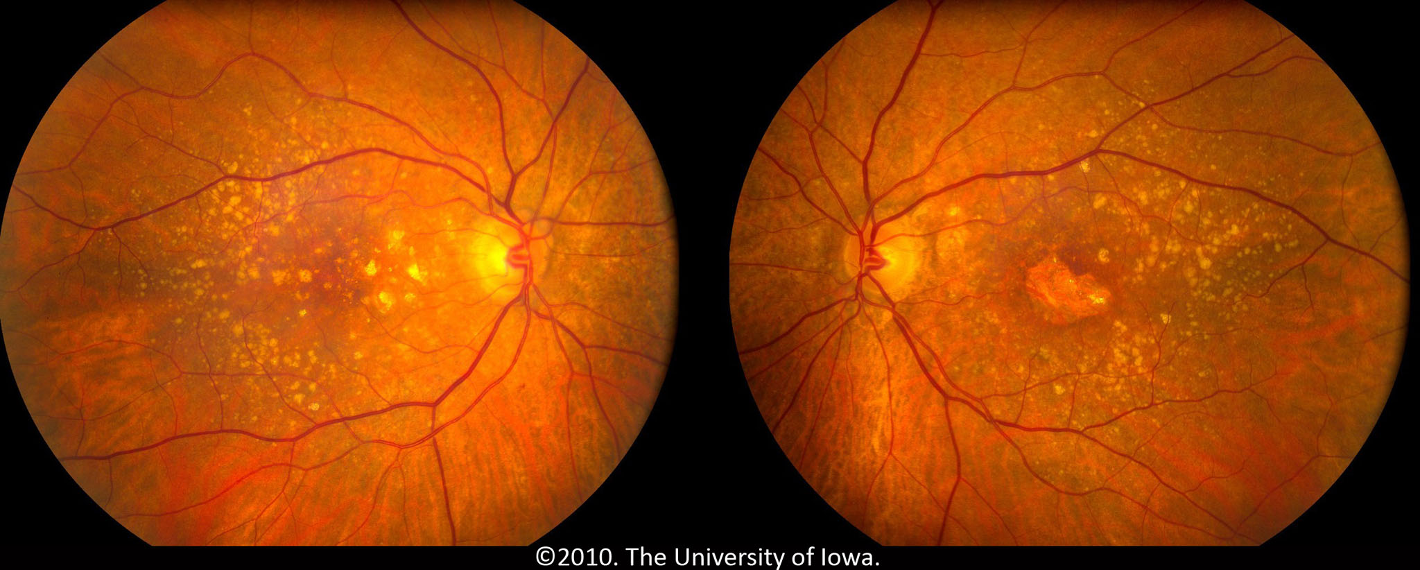 What Is Nonexudative Age Related Macular Degeneration Bilateral Early Dry Stage