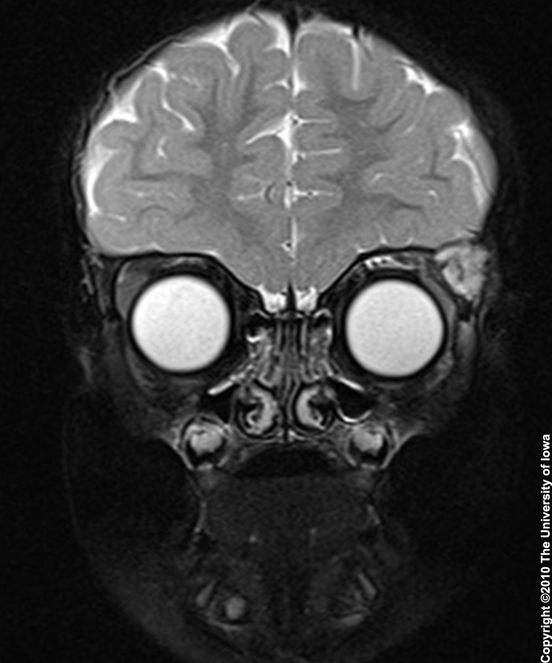Normal Brain Mri With Contrast Images Radiologia