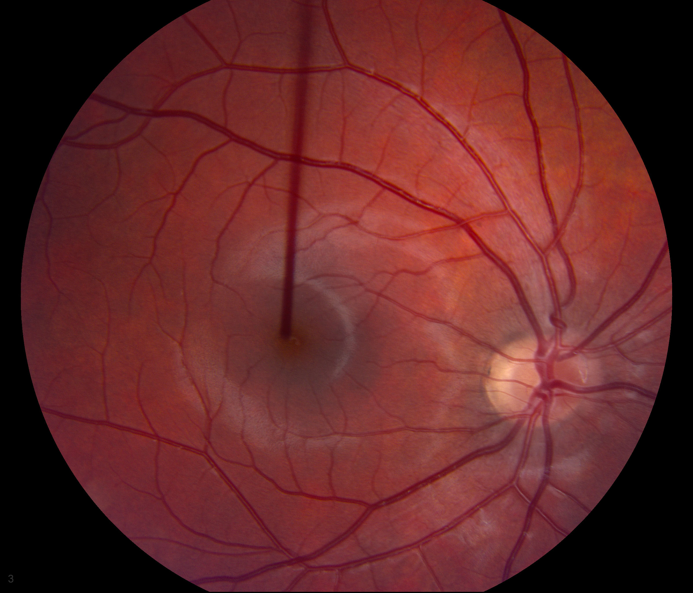 Unilateral Optic Nerve Hypoplasia In A Patient Desiring Surgical 