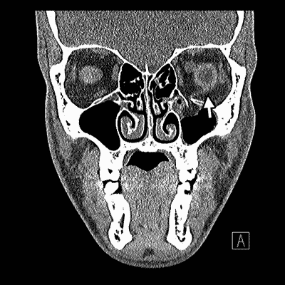 Figure 2a shows an anterior portion of the orbital floor fracture that involves inferior rectus entrapment