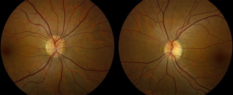 Color fundus photo of right and left eye