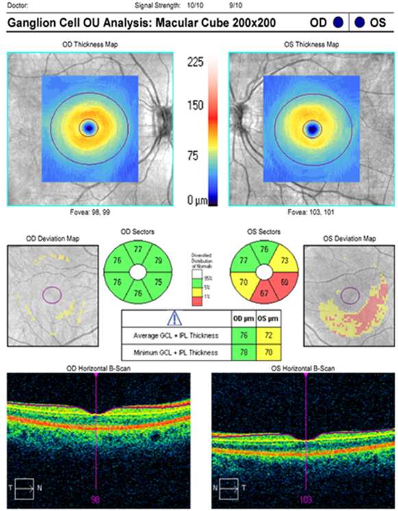 Optic Neuritis