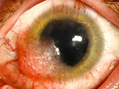 conjunctival squamous cell carcinoma