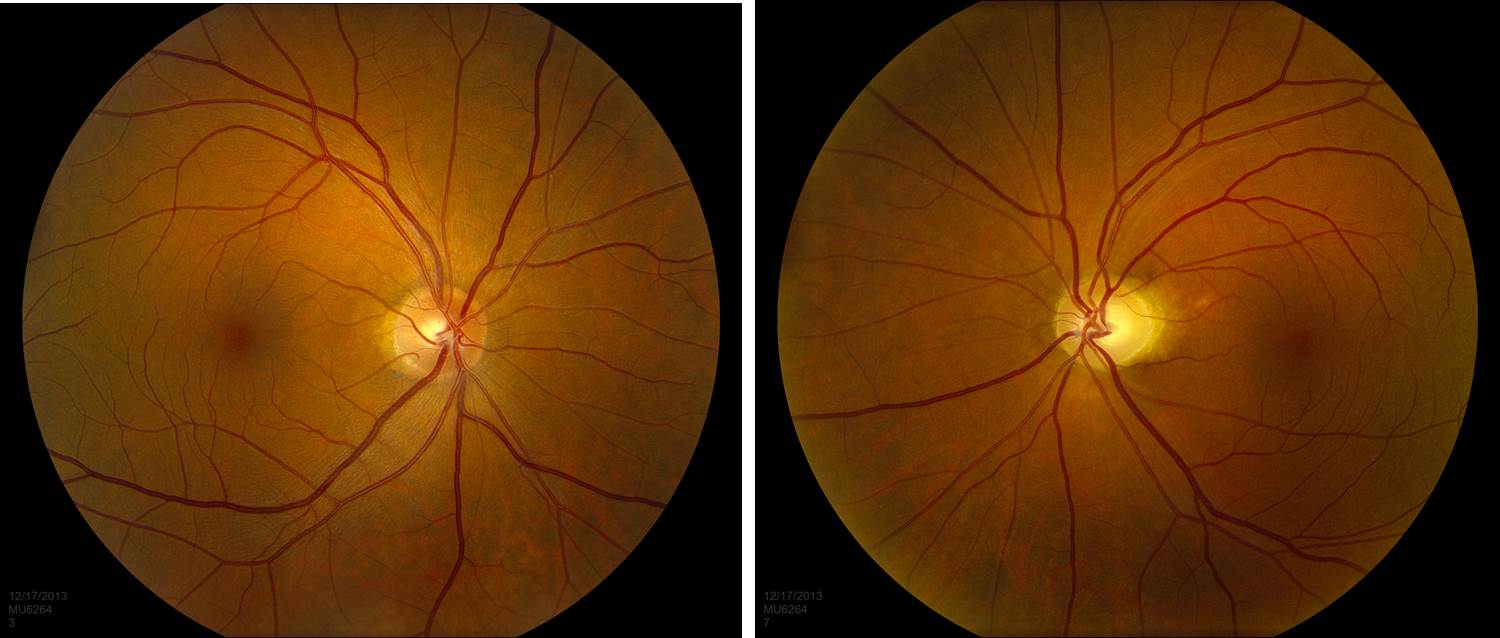 Dramatic Visual Recovery In Untreated Indirect Traumatic Optic Neuropathy