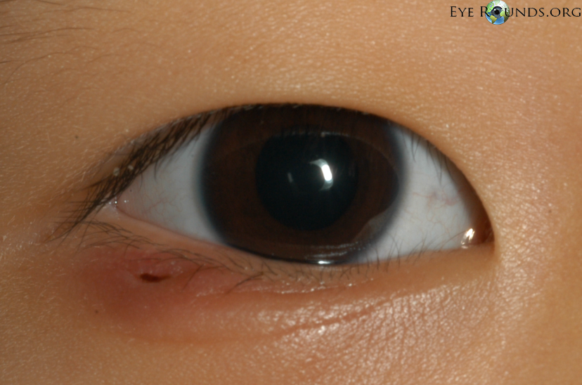 chalazion lower eyelid