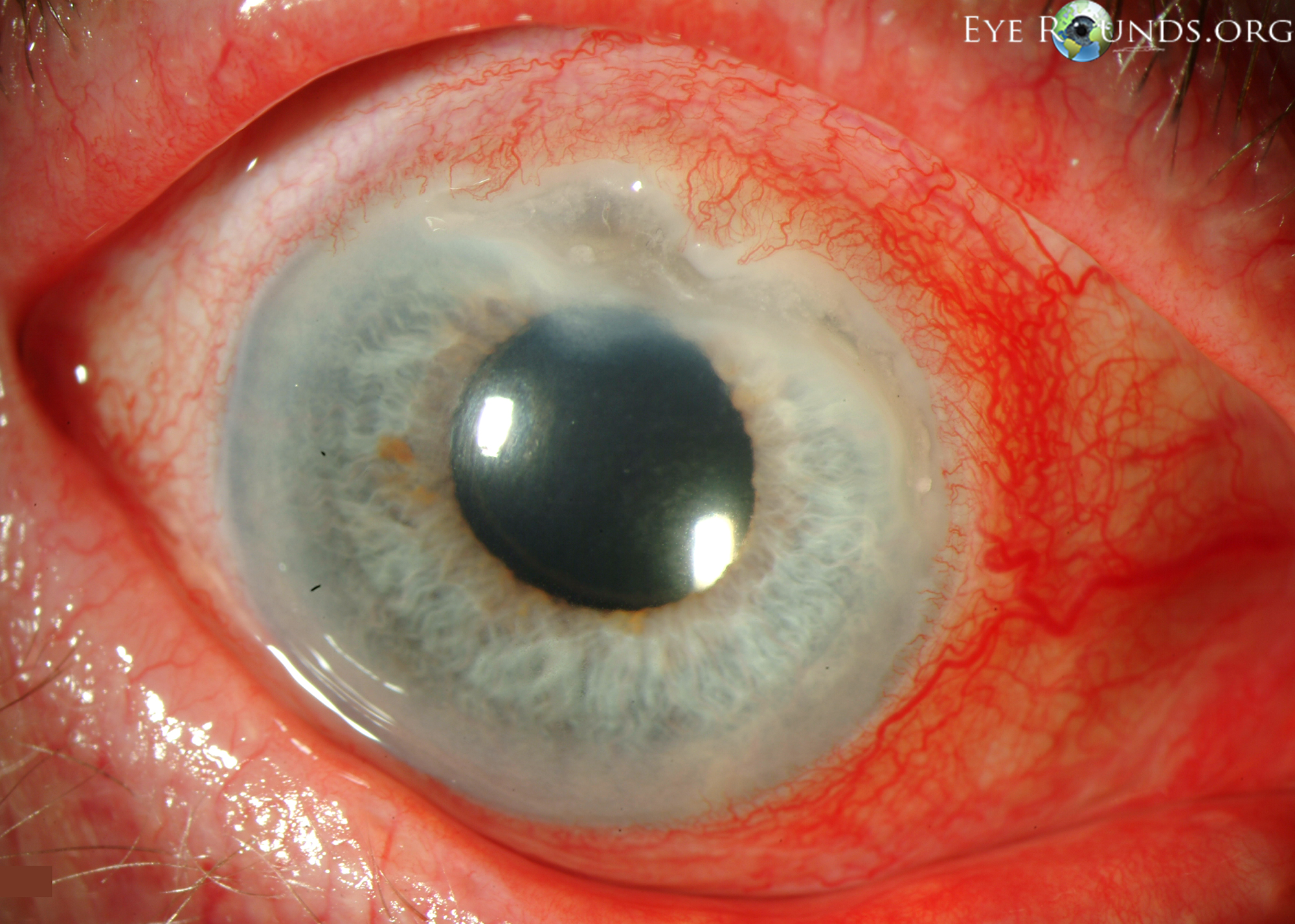 staphylococcal marginal keratitis