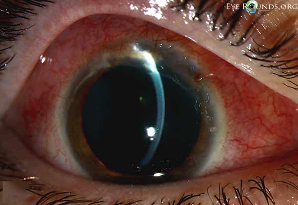Superior epithelial defect with 80% stromal thinning and adjacent sterile corneal infiltrates
