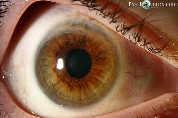 The eye appears less inflamed with resolution of corneal infiltrates. 