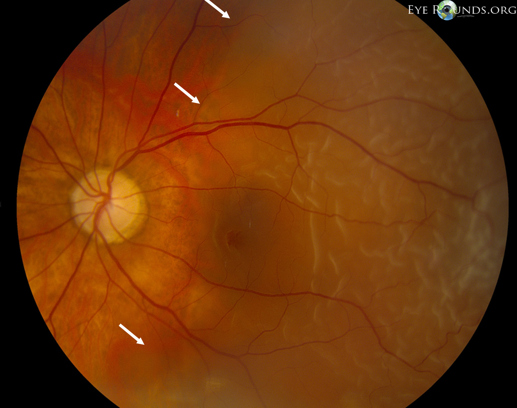 detached retina symptoms video