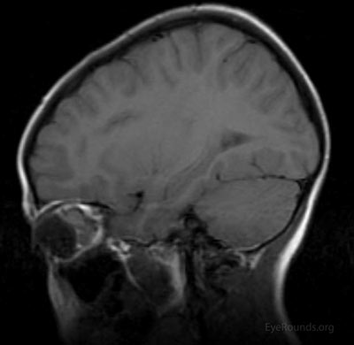 b) Sagittal T1 image demonstrating large non-encapsulated intraconal mass of the left orbit. 