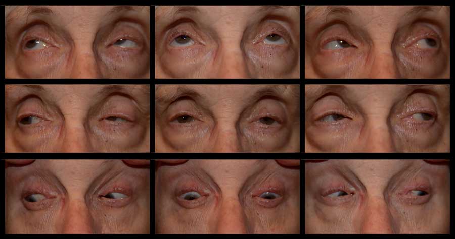 Sagging Eye Syndrome