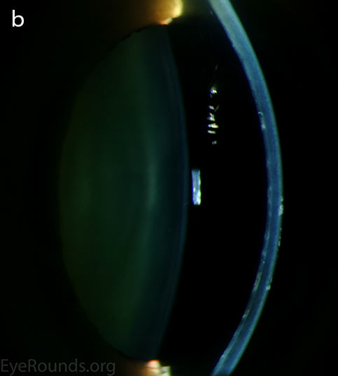 Diffuse inner corneal opacities