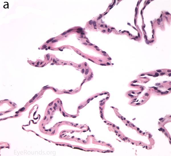Endothelial cell metaplasia in PPMD as seen with H&E stain