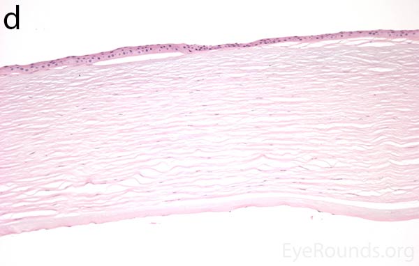 H&E stain of full-thickness corneal tissue obtained from PPMD patient showing bullous keratopathy with loss of endothelial cells, 50X