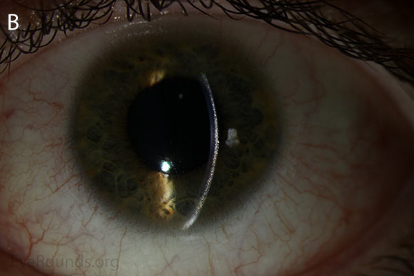 slit lamp, Punctate, needle-shaped crystals diffusely present throughout the corneal surface