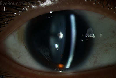 small anterior polar cataracts