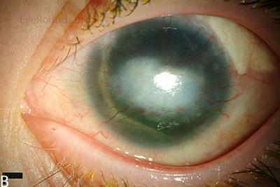 Slit lamp photographs of another patient with congenital aniridia. There is conjunctivalization of the left cornea due to stem cell deficiency and a central corneal scar. There is iris hypoplasia in both eyes.