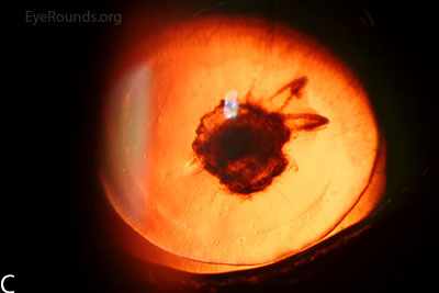 The cataract and corneal scars are demonstrated on retroillumination
